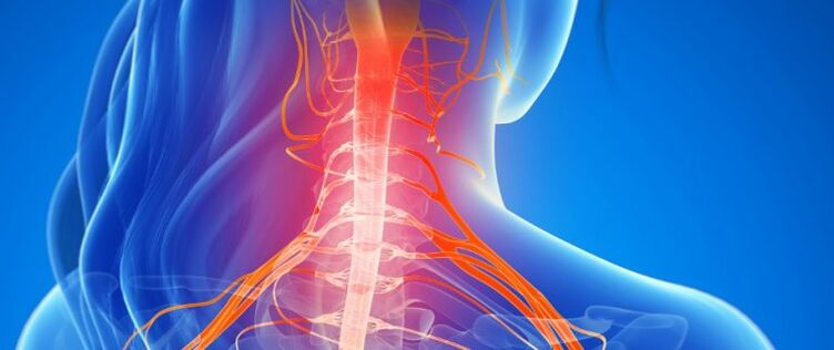 A gerincvelő ereinek összenyomása a nyaki gerinc osteochondrosisában