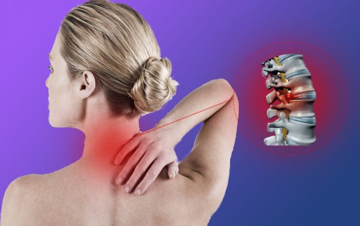 A nyaki gerinc osteochondrosisa intervertebralis herniák kialakulásához vezet