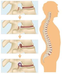 A nyaki osteochondrosis négy fejlődési szakasza