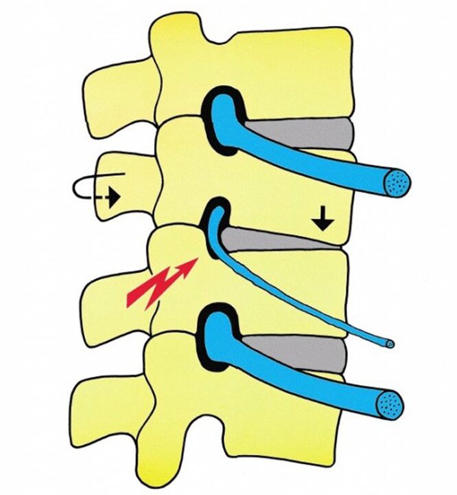 A nyaki osteochondrosisban nagyon gyakori a radikuláris szindróma
