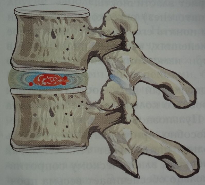 Az intervertebralis porckorong nucleus pulposusának károsodása a nyaki osteochondrosis első szakaszában