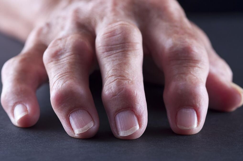 A bursitist az ujjak ízületeinek fájdalma, gyulladása és duzzanata jellemzi