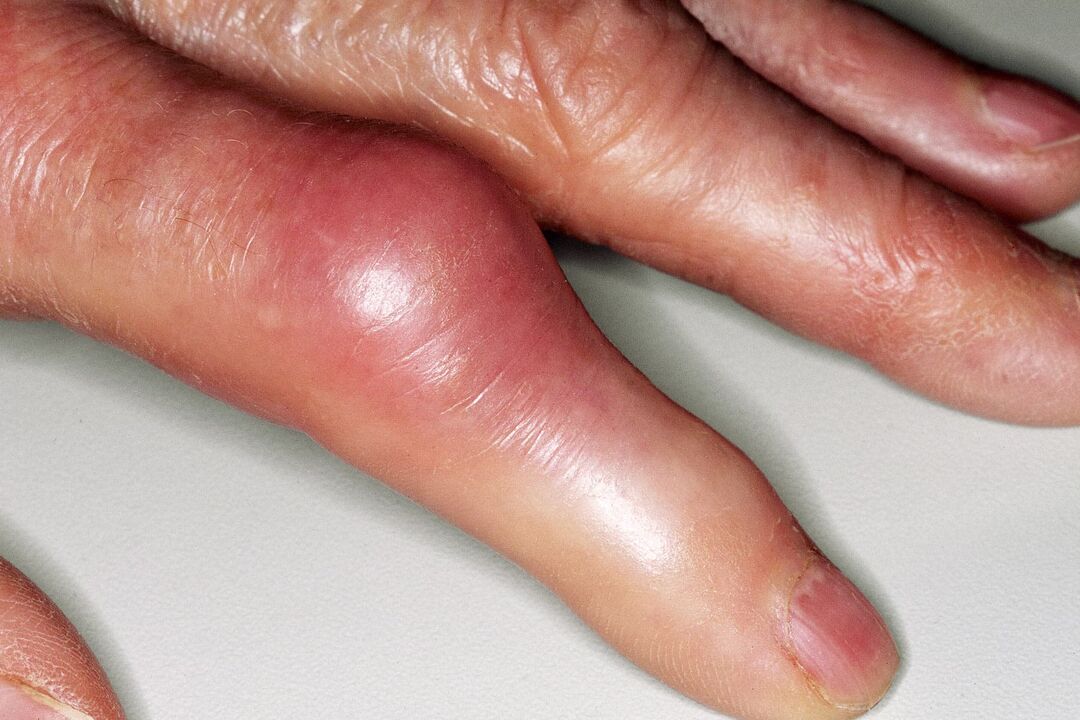 Az ujjízület duzzanata, deformációja és sérülés utáni akut fájdalom