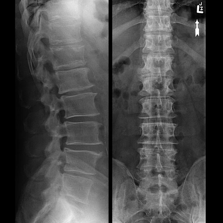 A gerinc bepattanása osteochondrosissal