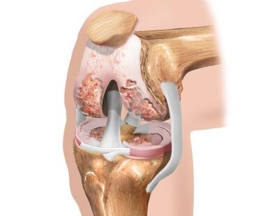 a térdízület pusztulása arthrosis miatt