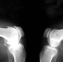 Arthrosis röntgenfelvételen