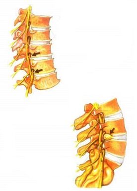 gerinc osteochondrosis illusztrációja